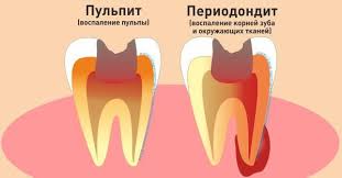 Психосоматика Периодонтита