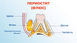 Психосоматика Периостита