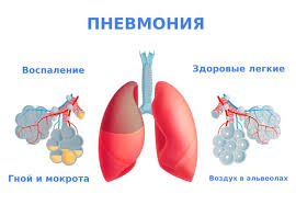 Психосоматика пневмония