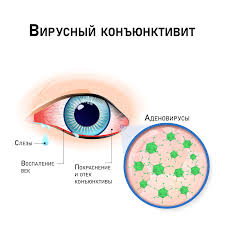 Психосоматика Вирусного Конъюнктивита