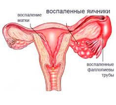 Психосоматика Воспаление придатков матки