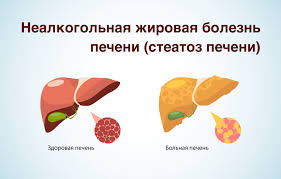 Психосоматика жировой болезни печени