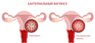 Психосоматика Дисбактериоз влагалища