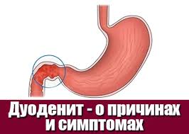 Психосоматика дуоденита
