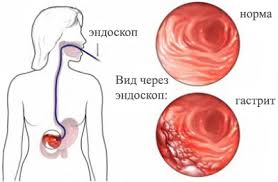 Психосоматика гастрита