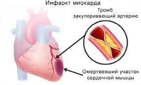 Психосоматика инфаркт миокарда
