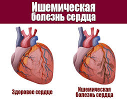 Психосоматика ишемическая болезнь сердца