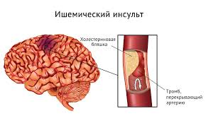 Психосоматика ишемический инсульт