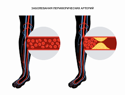 Психосоматика ишемия нижних конечностей