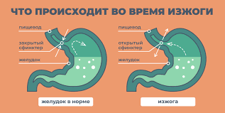 Психосоматика изжоги