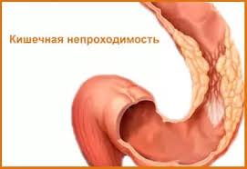 Психосоматика кишечная непроходимость