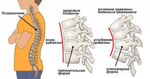 Психосоматика клиновидных позвонков