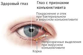 Психосоматика конъюнктивита