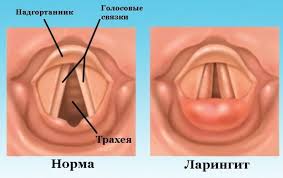 Психосоматика Ларингит