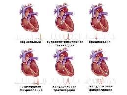 Психосоматика нарушения проводимости сердца