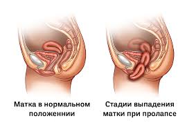 Психосоматика опущения матки