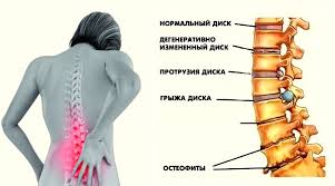 Психосоматика остеохондроз поясничный