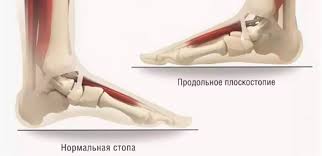 Психосоматика продольное плоскостопие