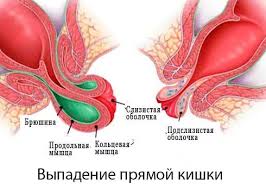 Психосоматика выпадения прямой кишки