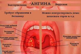 Психосоматика – ангина фолликулярная