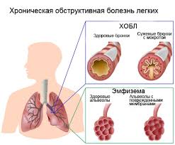Психосоматика – Хронической обструктивной болезни лёгких (ХОБЛ)