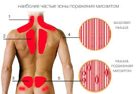 Психосоматика – Миозита